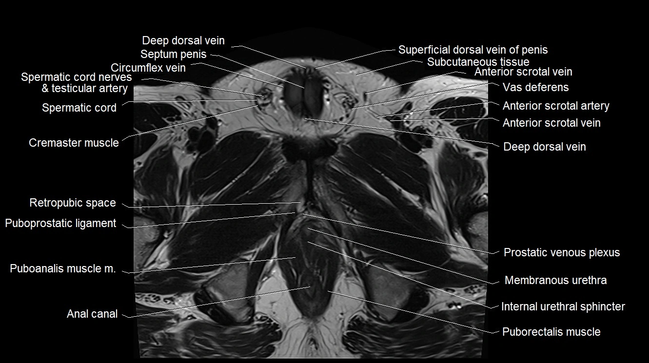 MRI 3T scrotum and penis axial cross sectional anatomy image 14.webp